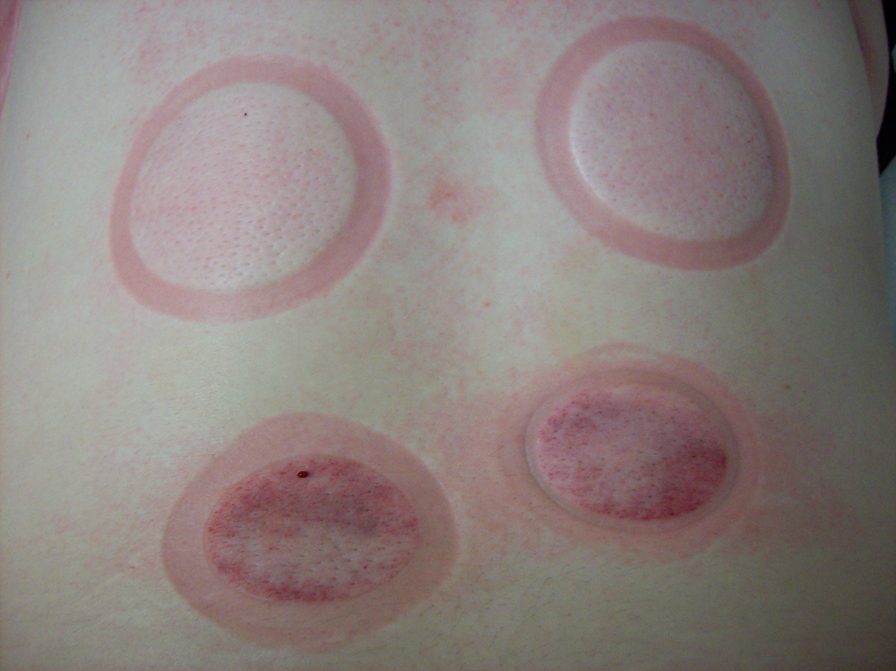 Cupping mark 1b